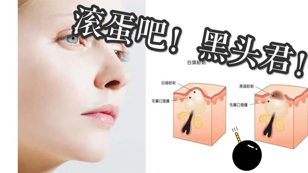看不爽的黑头要这样对付它(二)方法篇