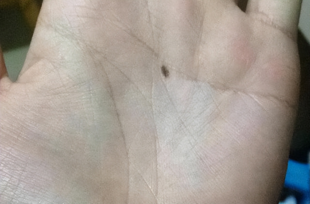 小孩痣长在什么地方代表什么,孩子身上的痣真的能预示未来