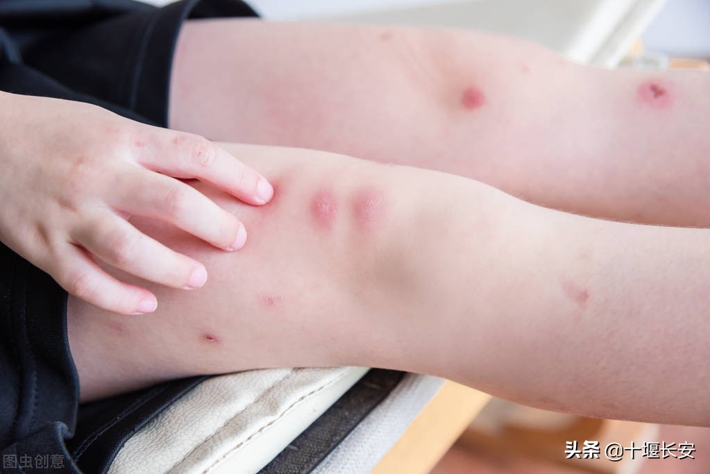 蚊子叮的包越大说明毒性越强吗,蚊子包最好有什么办法处理
