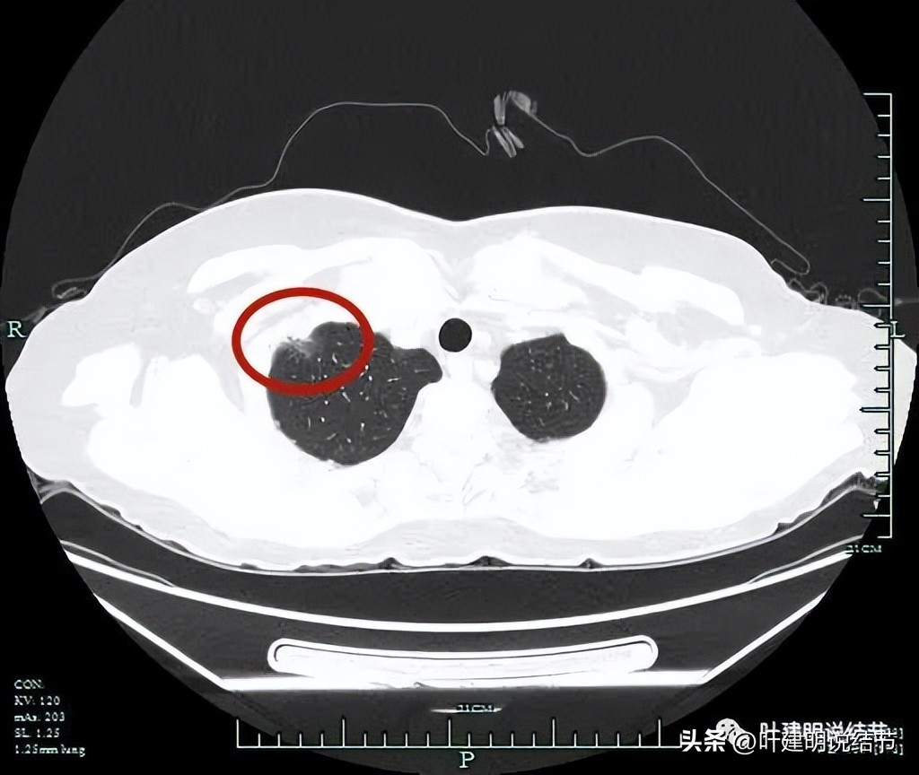 肺癌病理的肿块是硬的吗,肺癌病灶什么样