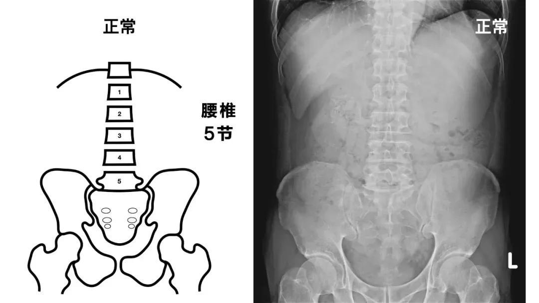 济南强直性脊柱炎脚后跟疼,强直性脊柱炎引起脚跟肿痛