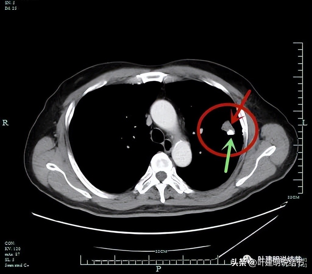 pet判断淋巴结转移,petct判断癌有没有转移准确吗