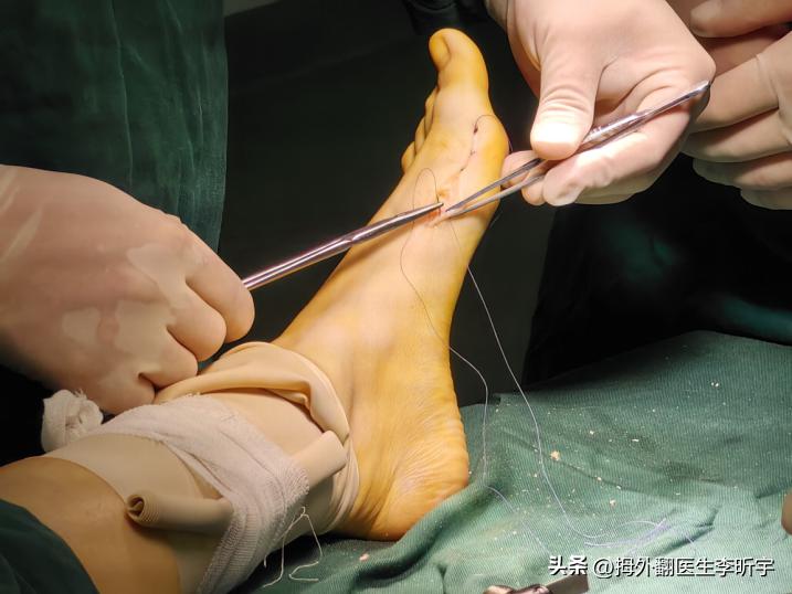 拇外翻矫正器真的有用吗,拇指外翻矫正器是智商税吗