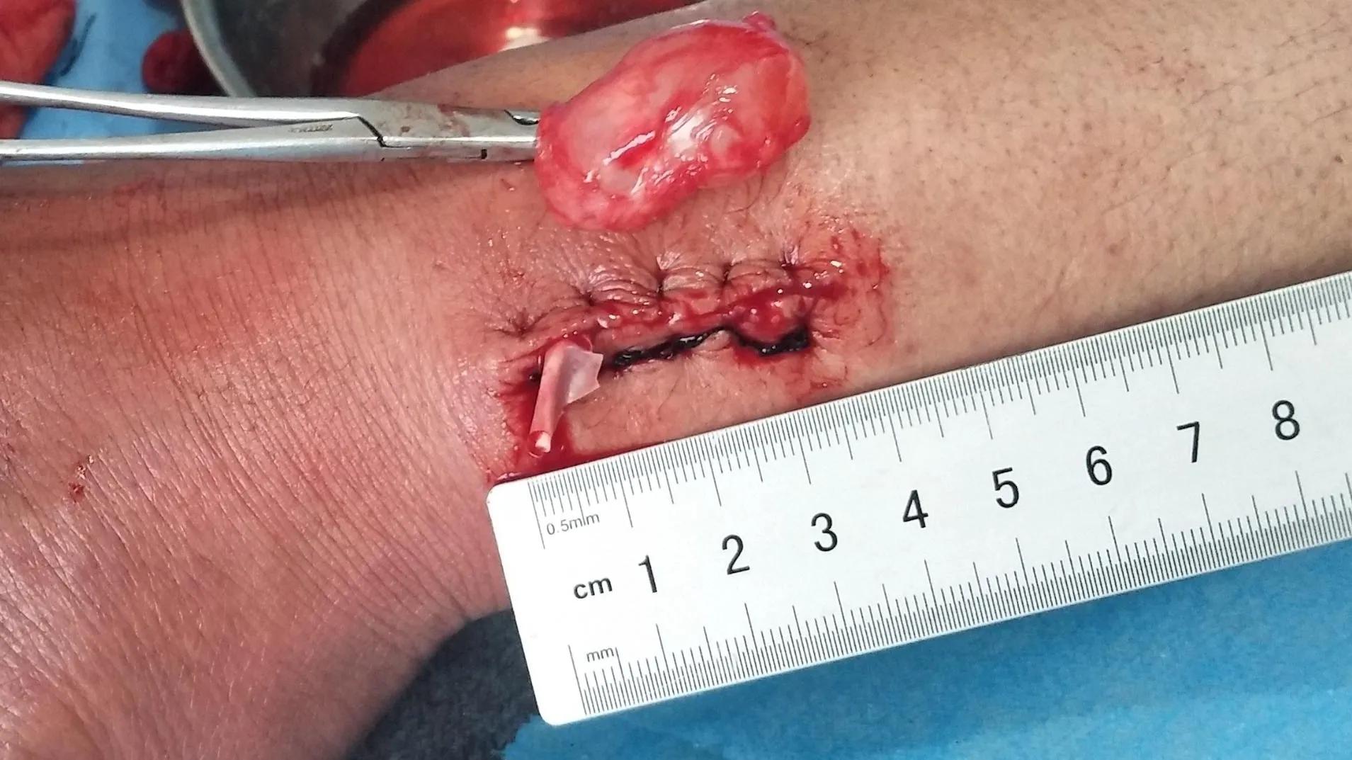 手背上长了个小凸起的包不痛不痒,手背突然起了个包