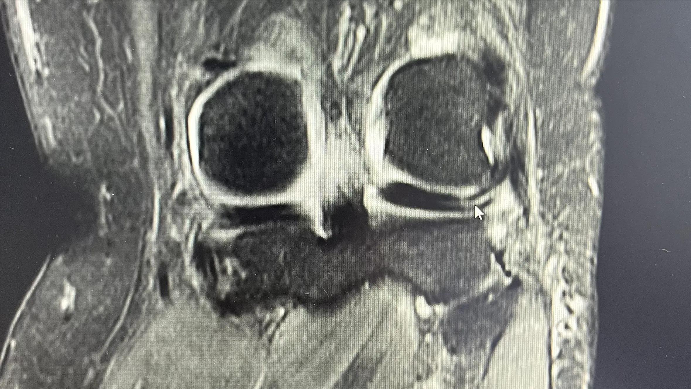 半月板的轻微损伤要注意什么,半月板损伤两年多了最好的方法