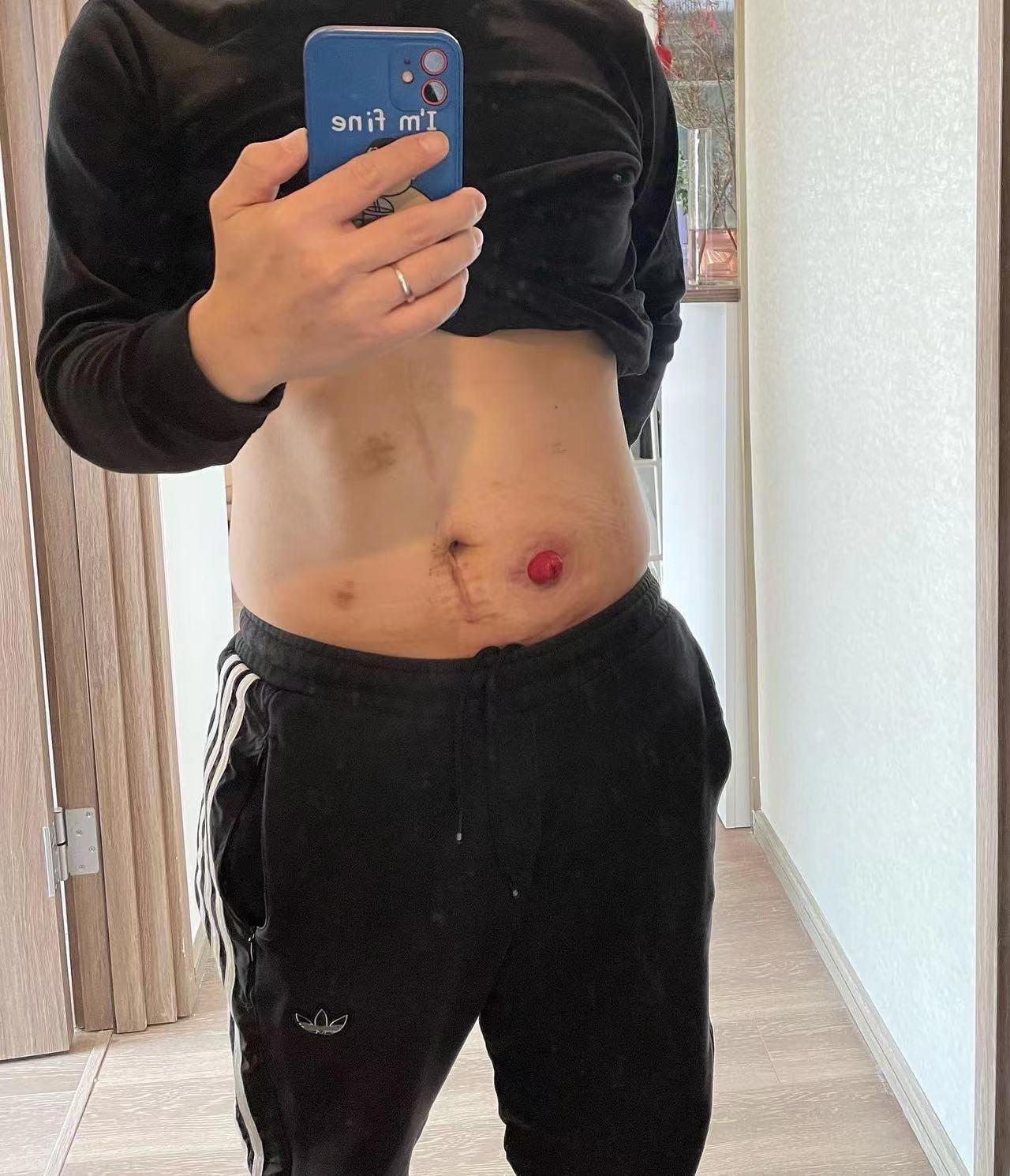 确诊不死癌,确诊癌症但是一直不死