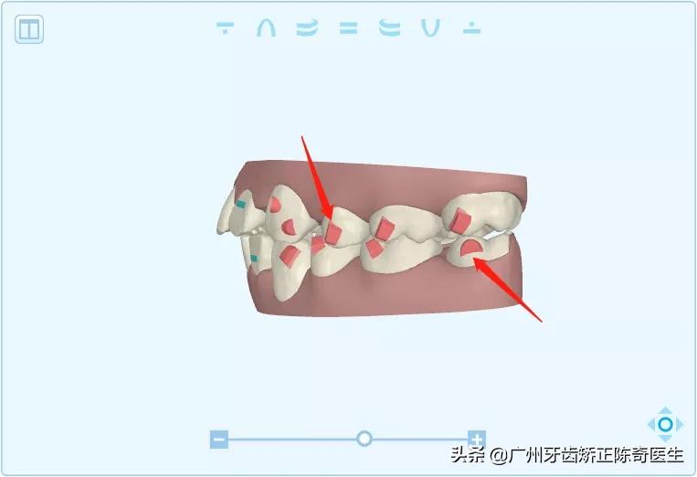 附着在牙齿上面硬硬的东西是什么,牙齿连接处有小疙瘩