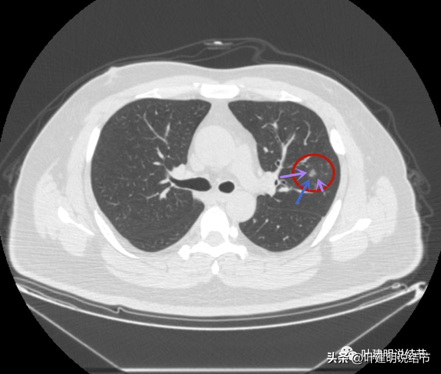 如何判断肺磨玻璃结节是高危结节,肺上有混合磨玻璃结节要注意什么