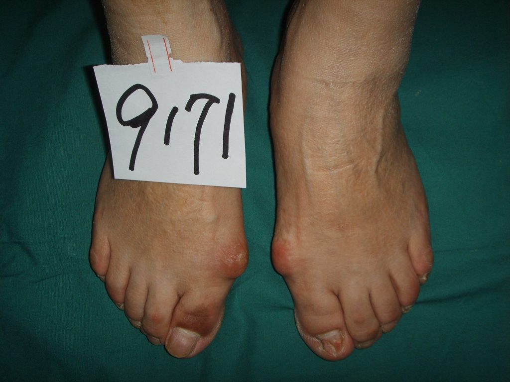 拇外翻疼痛怎么办,拇外翻疼痛的治疗方法药物