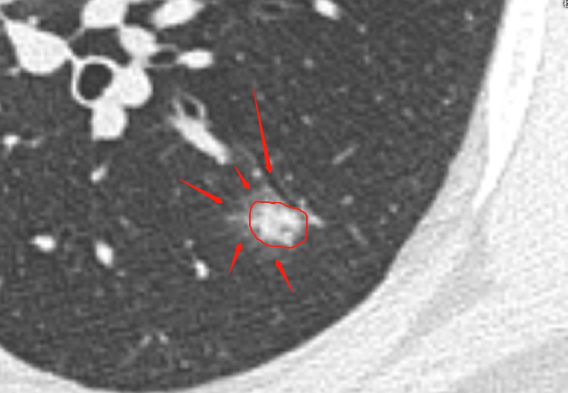 肺结节进一步检查排除肿瘤,肺结节4mm报告建议复查