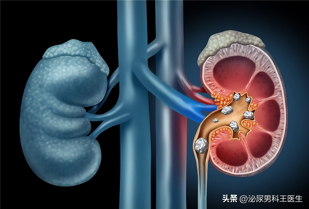 尿毒症注意三个坏习惯,为何尿毒症越来越多医生直言