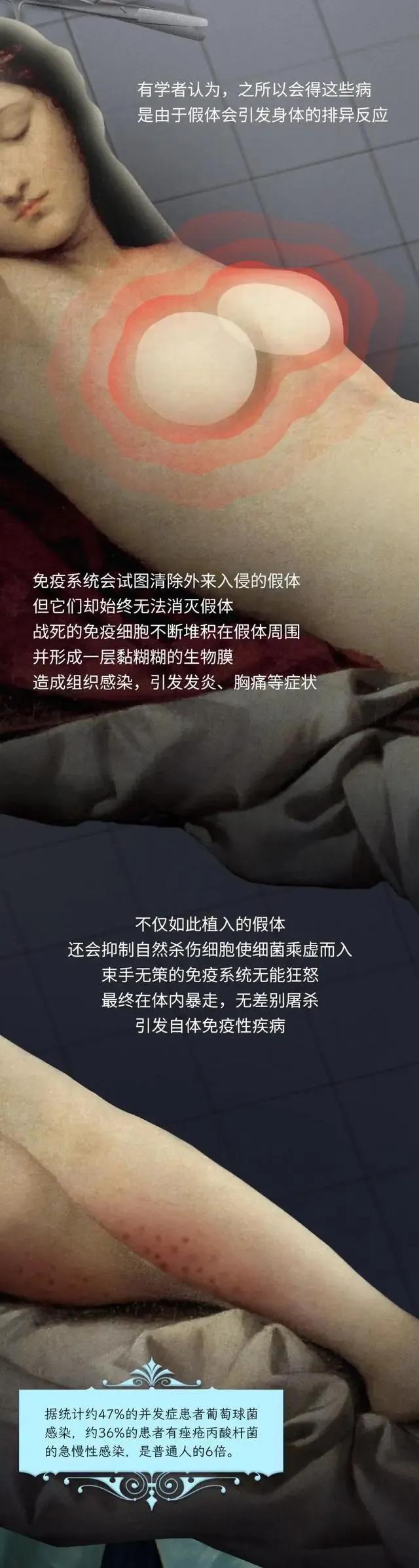 第一个隆胸的女人,全球最红隆胸女人