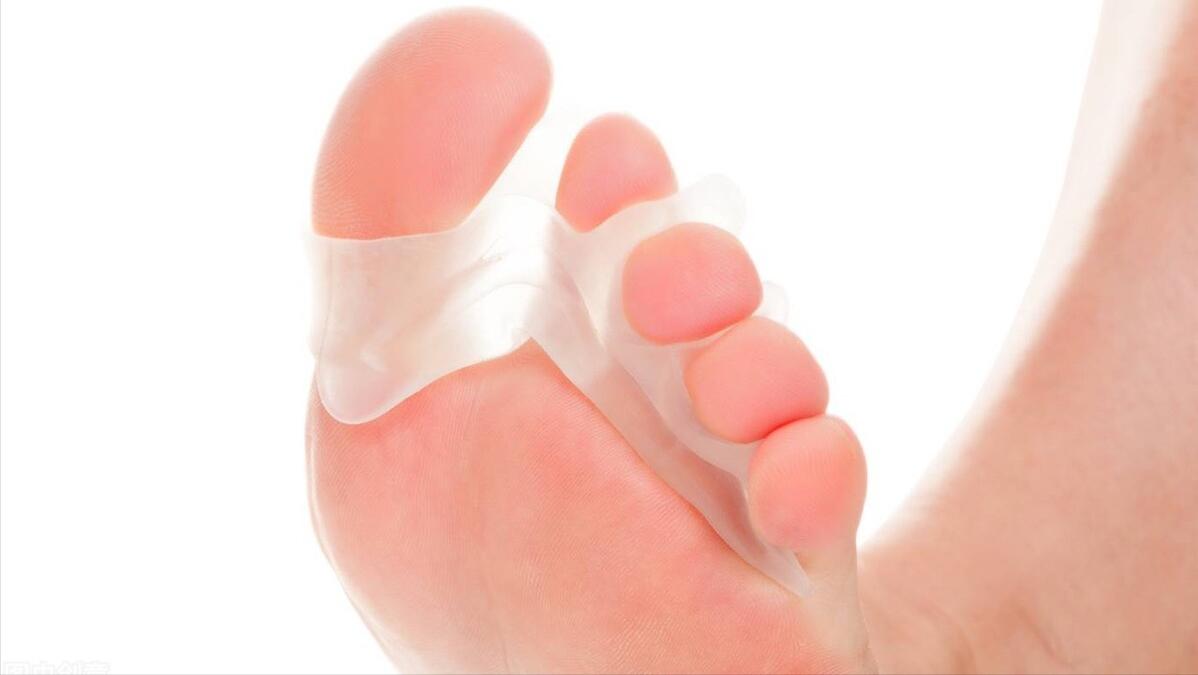大拇脚趾外翻用什么矫正方法,大脚趾外翻歪怎么办
