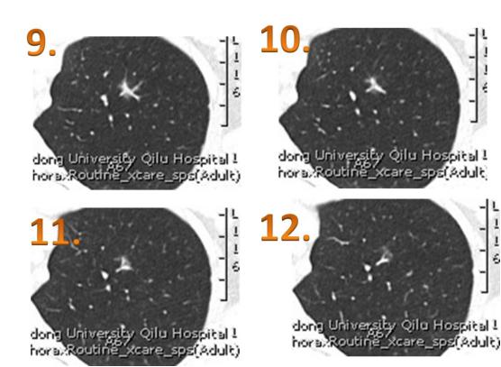 70%磨玻璃肺结节无需着急手术,磨玻璃结节5mm医生说原位癌