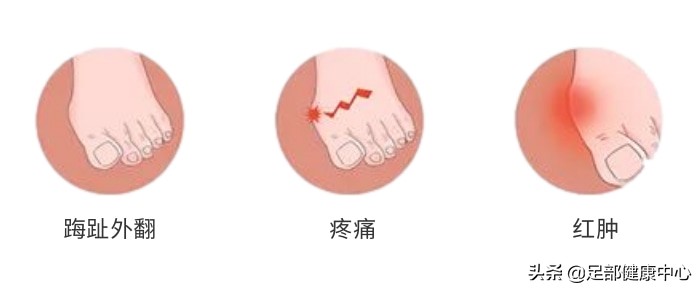 拇趾又歪又肿痛！这个女性高发病你得要小心
