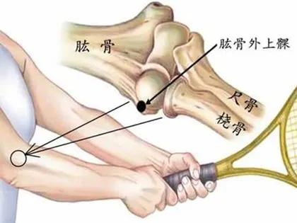 网球肘会引起胳膊肘伸不直吗,网球肘引起整个胳膊疼怎么办呢