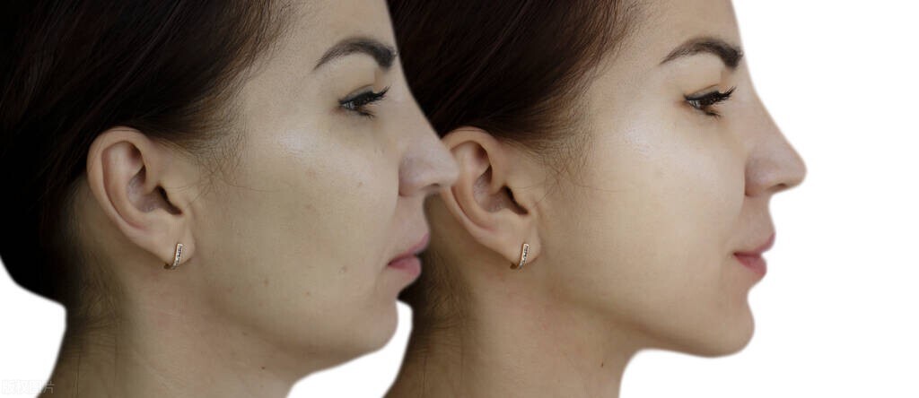 嘴突兔牙矫正哪种牙套适合,骨性嘴凸戴牙套整个过程