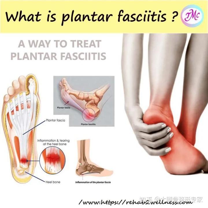 足底疼痛夜间加重,足底和足跟痛是怎么回事