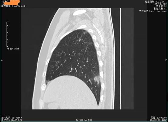 新冠复阳会感染吗,新冠复阳还是二次感染