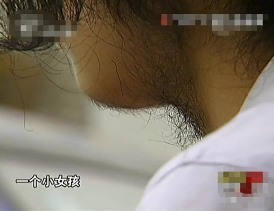 花季少女意外车祸后长胡子,14岁妙龄少女车祸后长胡子