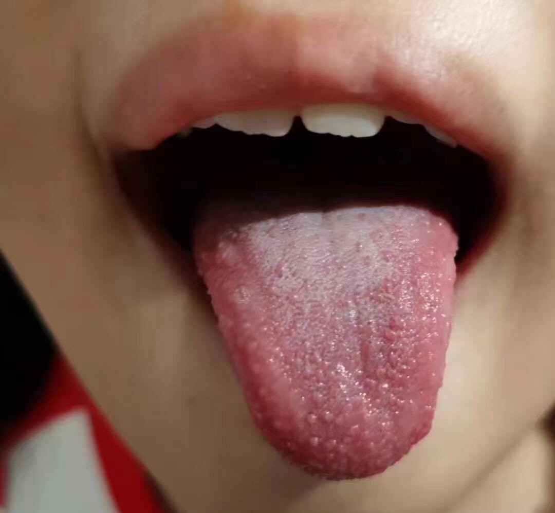 腺样体肥大打针有用吗,儿童腺样体肥大耳朵痛要不要打针