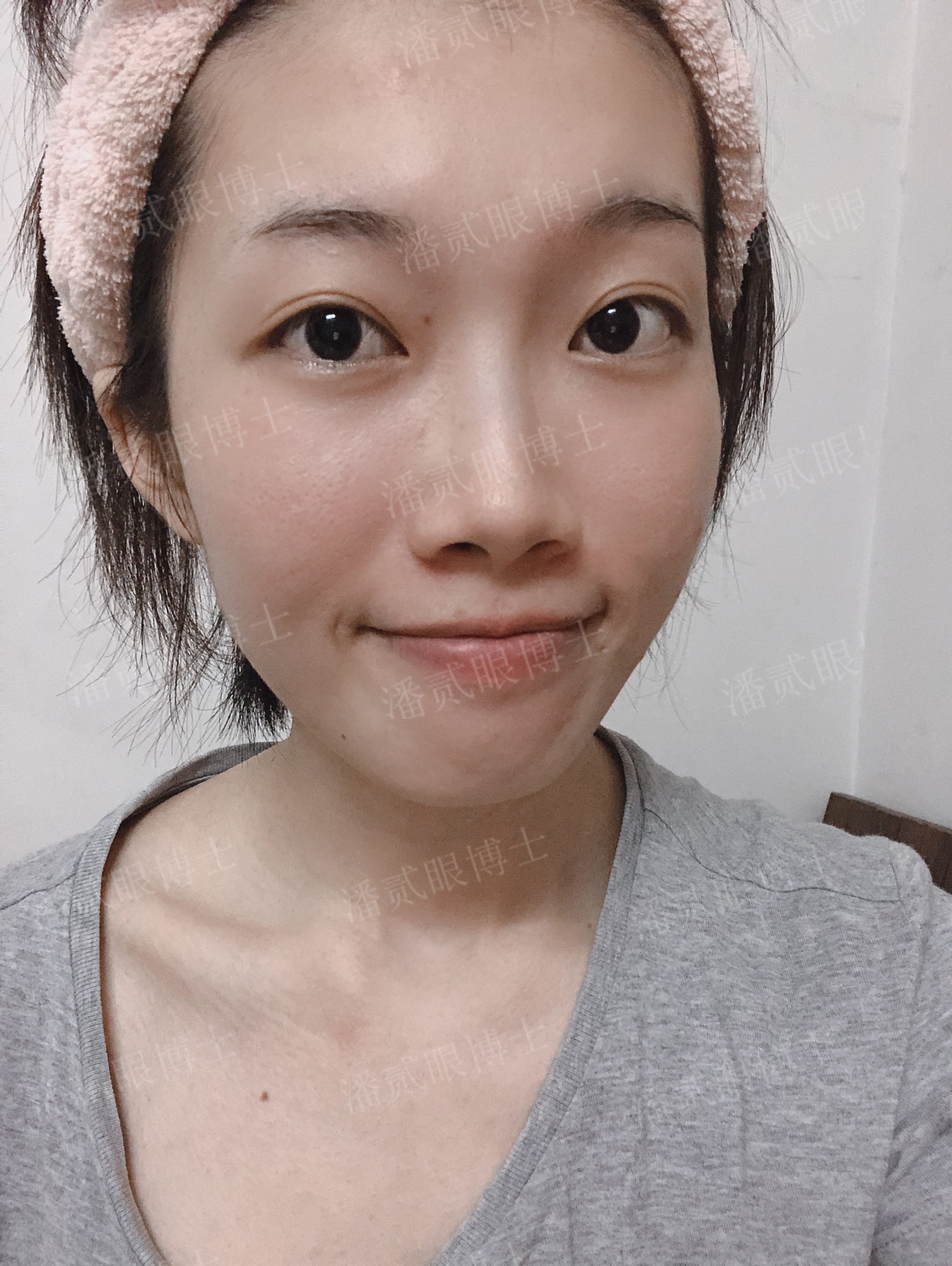 广州姑娘变美后亲述：“我的双眼皮切得很小，只有1厘米多一点”