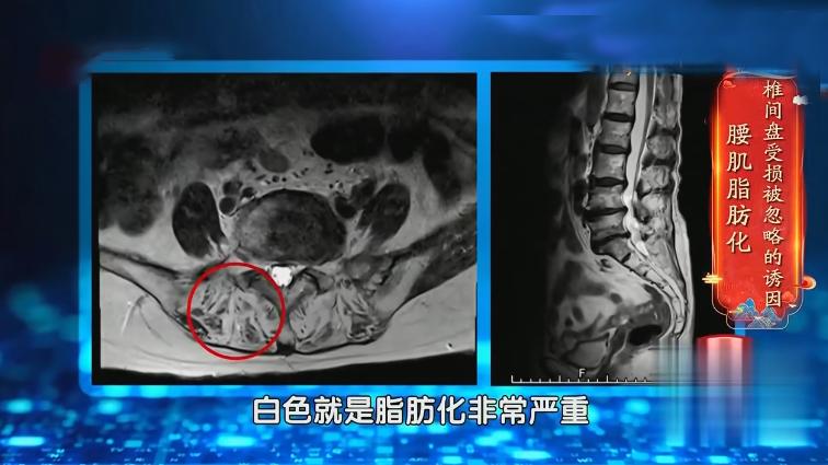 脊柱病三个动作自愈方法,椎间盘突出可以做脊柱屈的动作吗