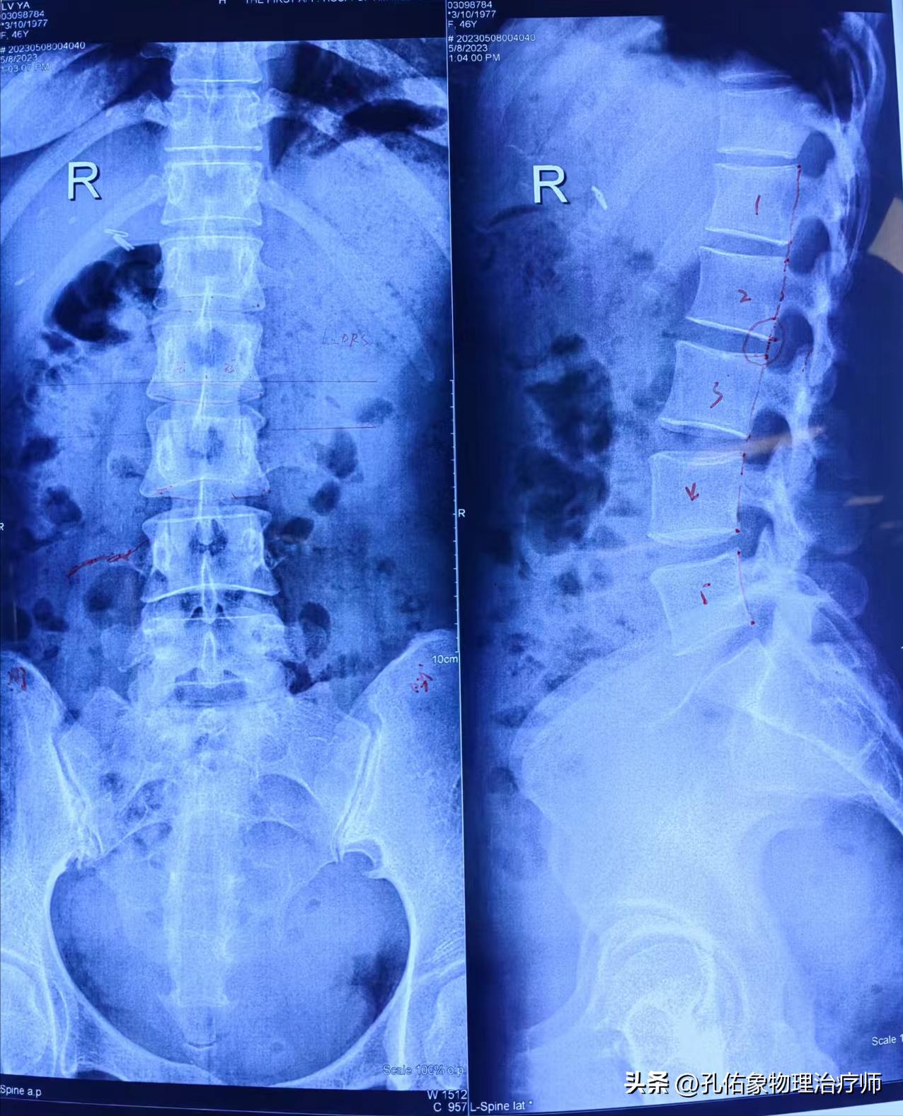 从臀部到小腿麻木疼痛怎么回事,臀部小腿酸胀是怎么回事