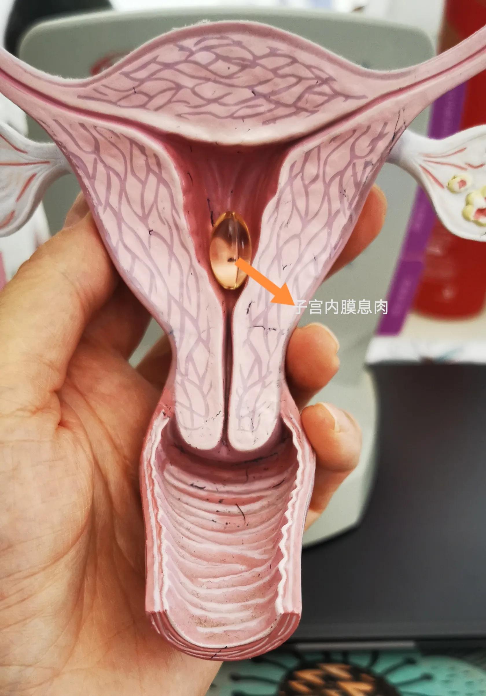 子宫内膜息肉中医,子宫内膜息肉手术需要住院吗