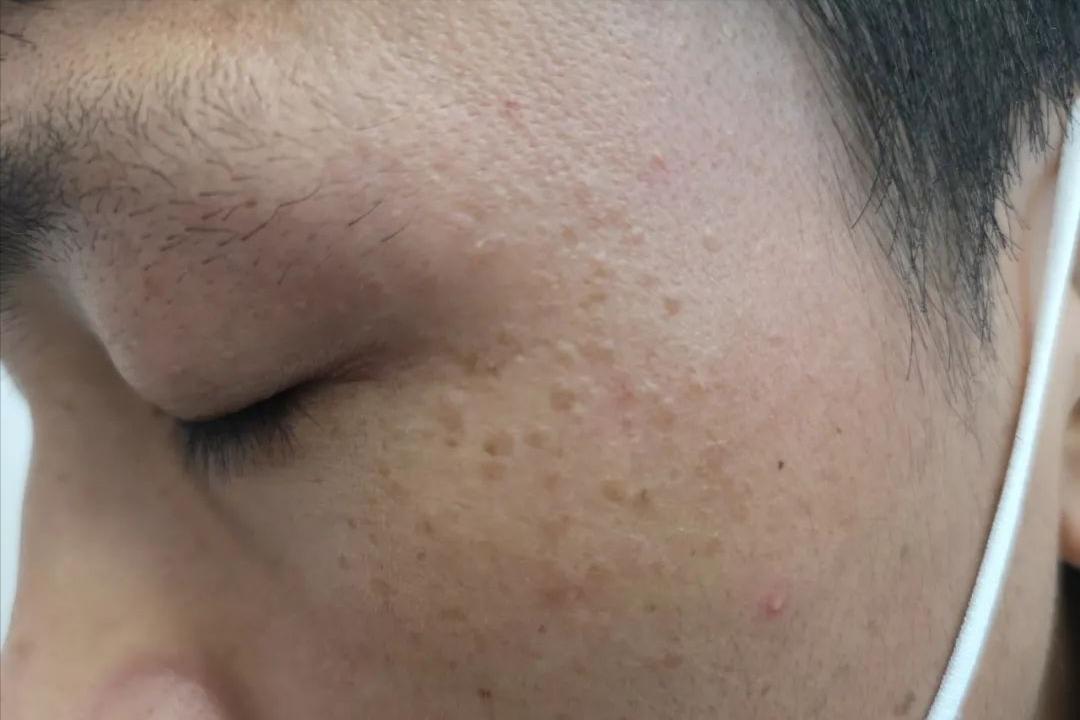 hpv和疣是一种病吗,hpv病毒疣是什么样的