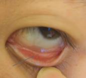 儿童鼻出血的原因及治疗,儿童反复鼻出血怎么能治愈