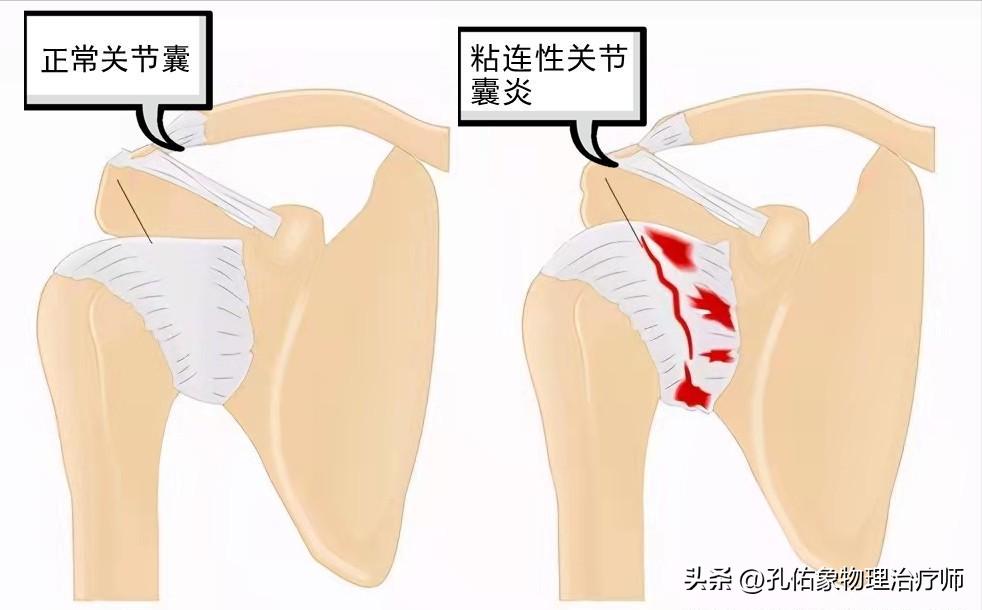 肩周炎可以自愈吗,肩周炎能不能自愈