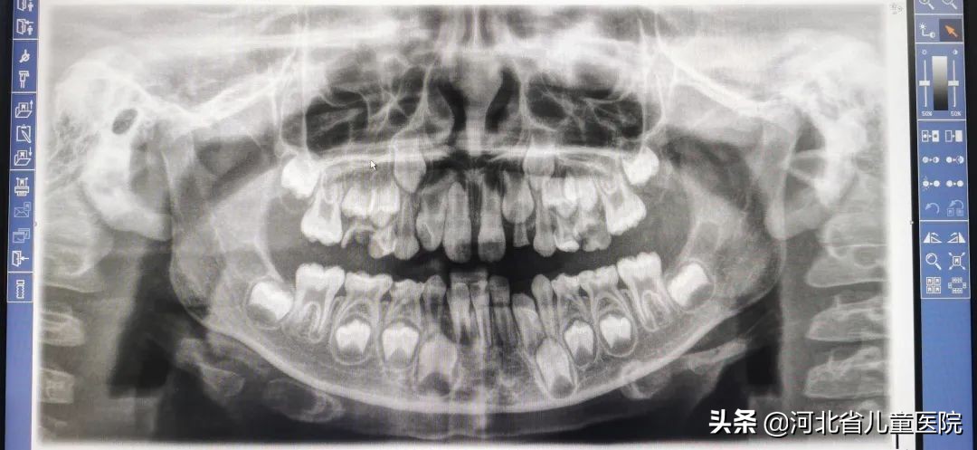 小孩有多生牙如何矫正,多生牙术后注意事项