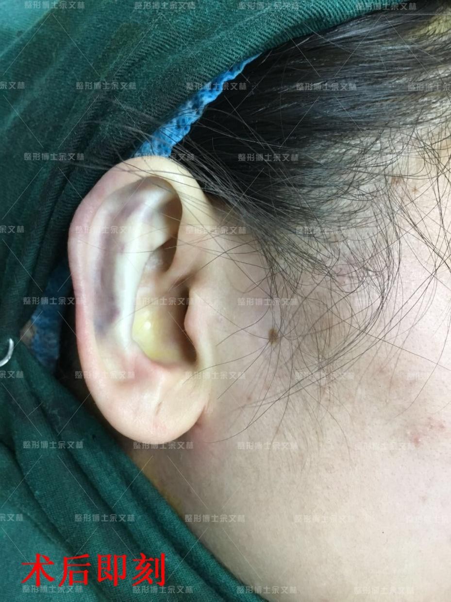 招风耳能整成正常耳朵吗,单侧招风耳有什么影响