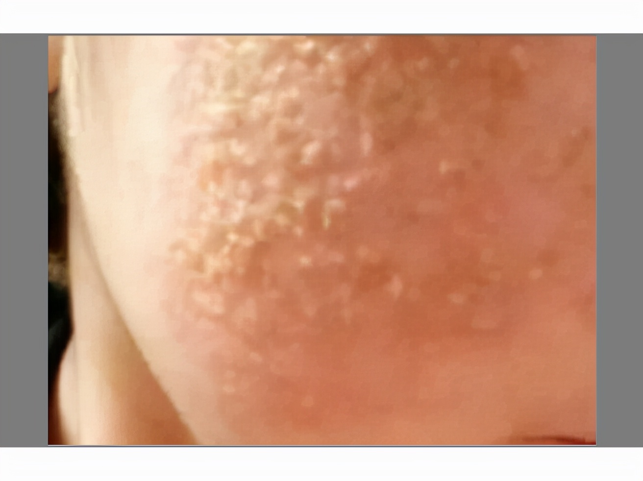 改善毛孔松弛粗大偏方,毛孔变粗大的解决方法