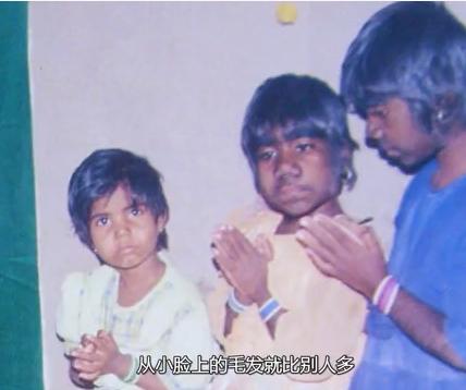 故事:非洲17岁女孩长满络腮胡,毛发从鼻孔长到脖子,身体有何异常