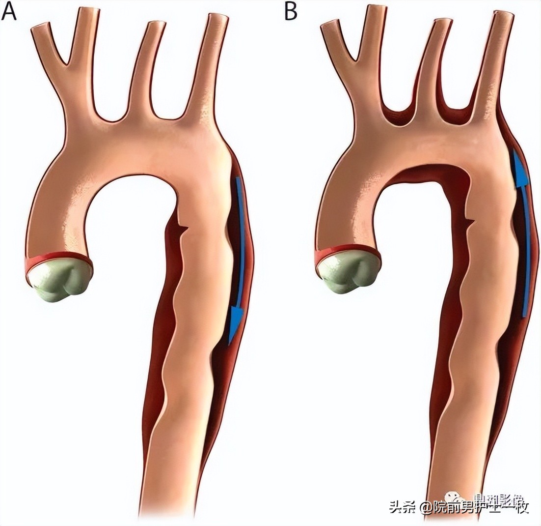 胸痛患者如何排除主动脉夹层,胸痛患者怎么处理