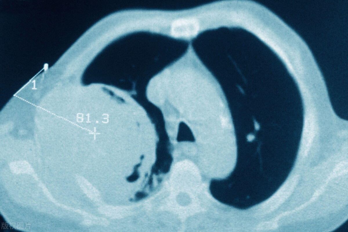 一夜过来手指变杵状指是不是肺癌,杵状指是肺癌的前兆吗