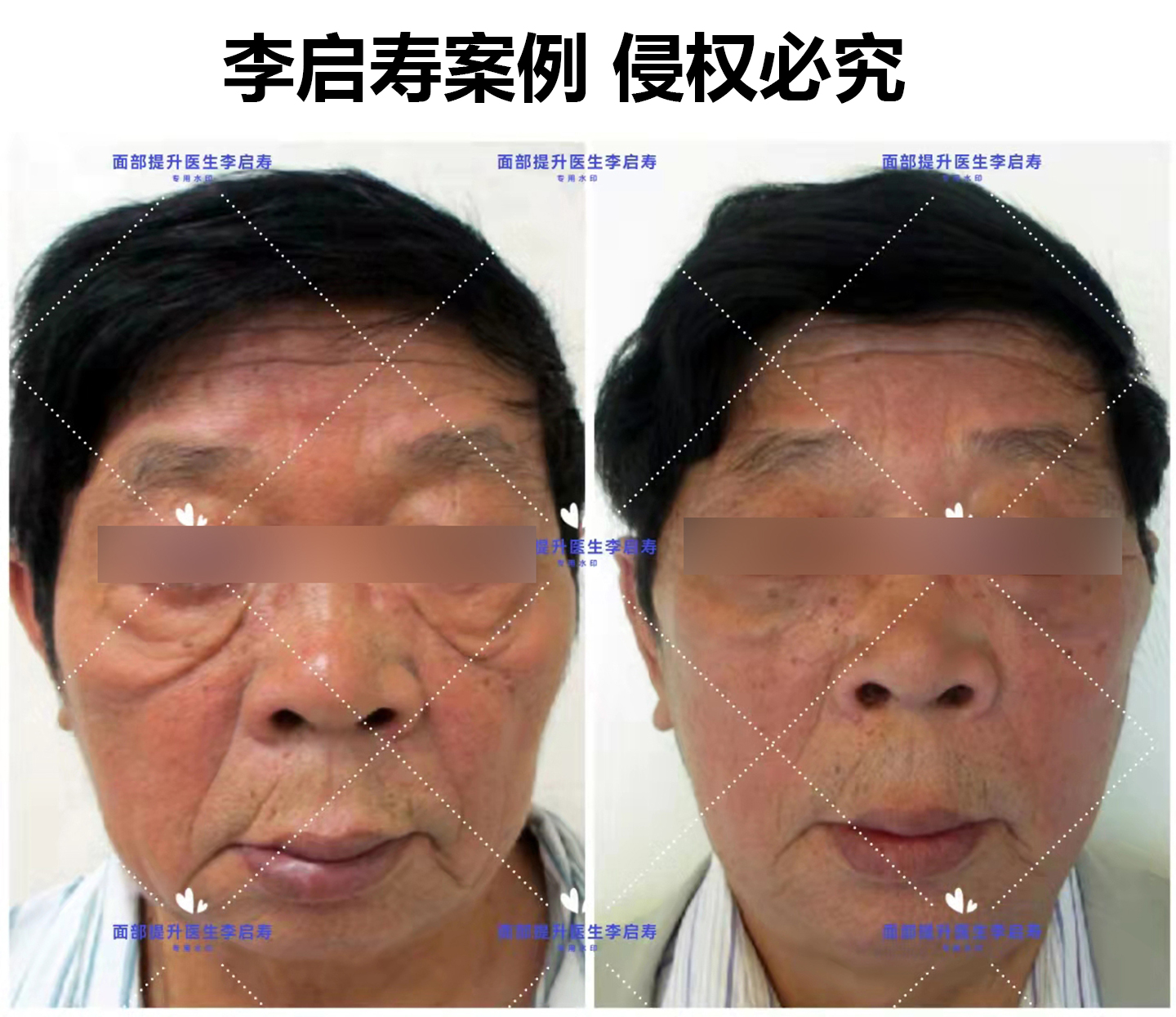 面部提升整形失败如何修复,面部提升年轻化术真实案例