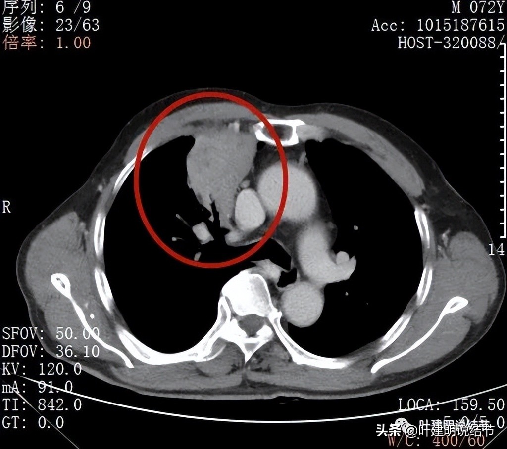 经验：肺占位超6厘米，不是癌还会是什么？临床上仍得多个心眼