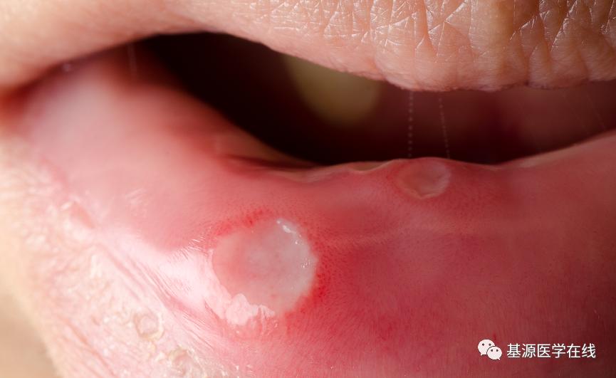 口腔溃疡反复发作中医辨证治疗,十岁女孩口腔溃疡反复怎么回事