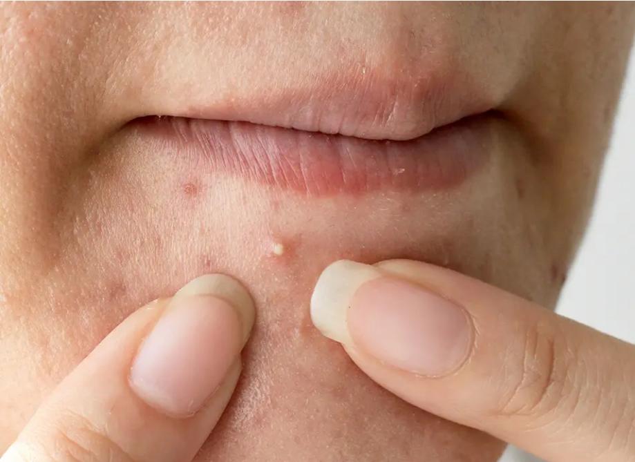 脸上长黑头粉刺什么原因,脸上长粉刺的原因和解决方法