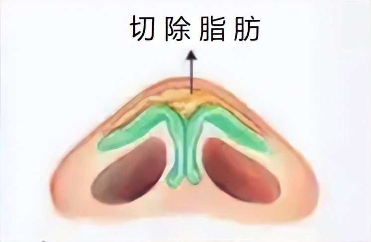 鼻头肥大用假体抬高鼻头能改善吗,鼻炎导致鼻头鼻翼肥大还能恢复吗