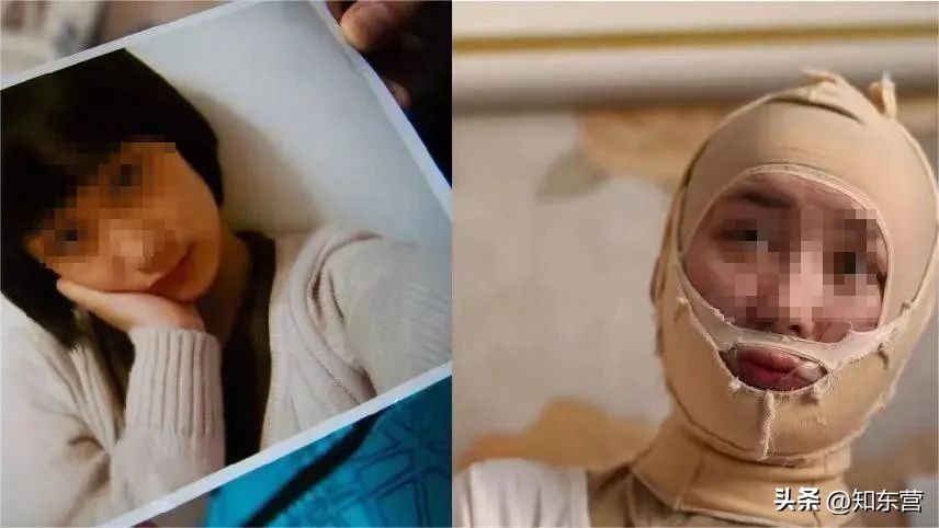 遭男友泼汽油烧伤的女孩现状,被富二代泼油毁容的女孩