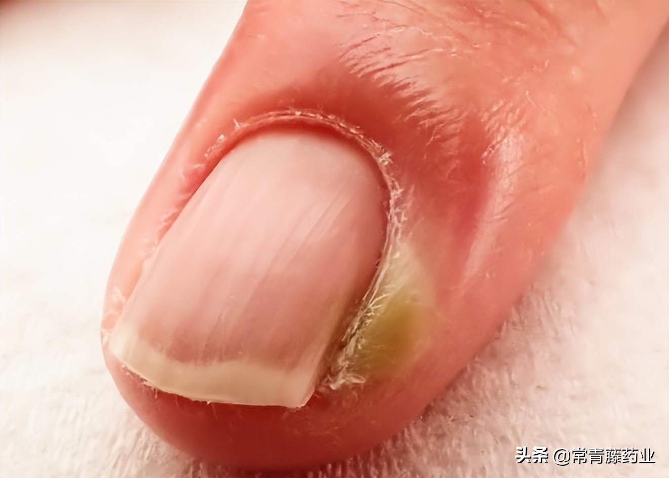 甲沟炎的痛苦程度,甲沟炎折磨人