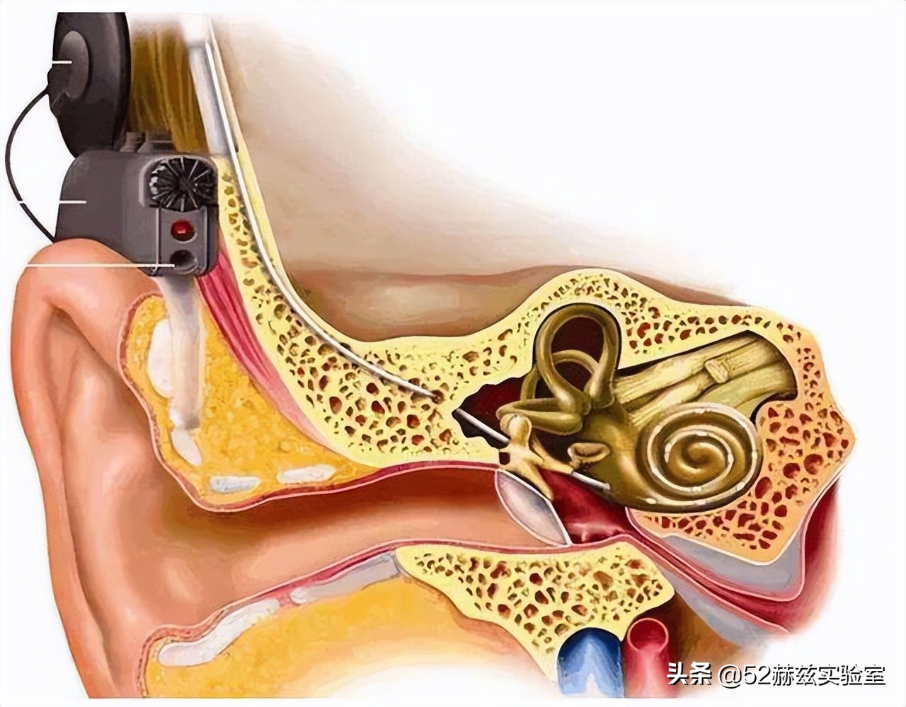 国产人工耳蜗怎么样,进口人工耳蜗价格表