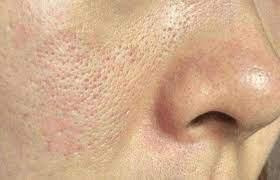 医生解决毛孔粗大小妙招快速有效,毛孔粗大难改变用好这三招全不见