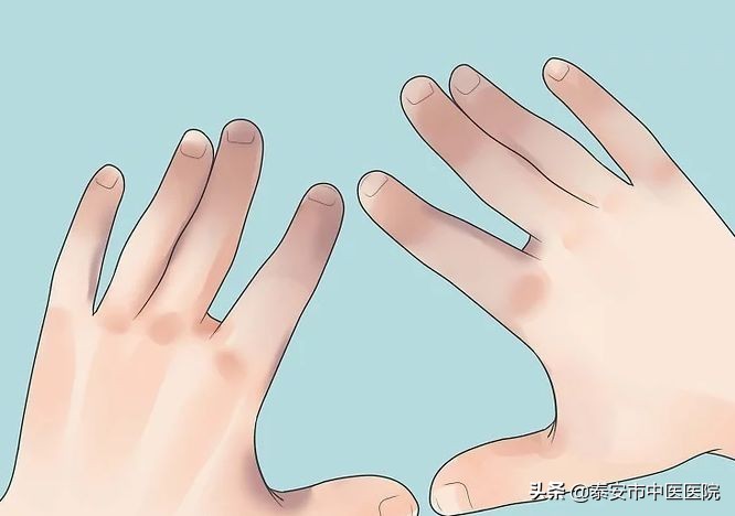 中医治疗冻疮最好的医院,华山医院治疗冻疮