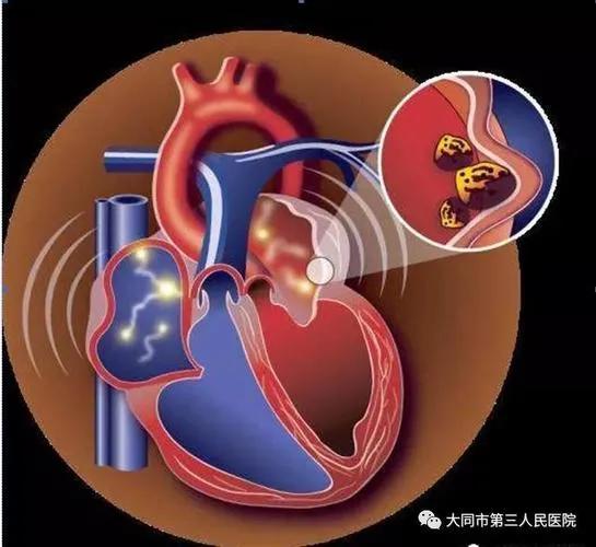 房颤属于静脉血栓需用什么药,房颤有可能导致脑梗吗