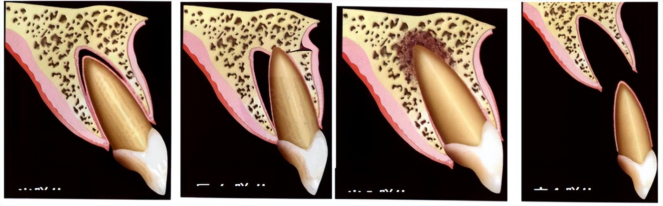 摔掉牙齿怎么补救,摔了一跤牙怎么快速牢固